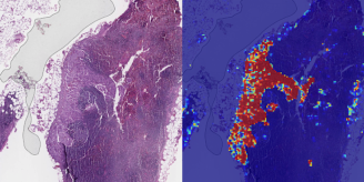 google ai breast cancer