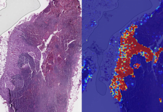 google ai breast cancer